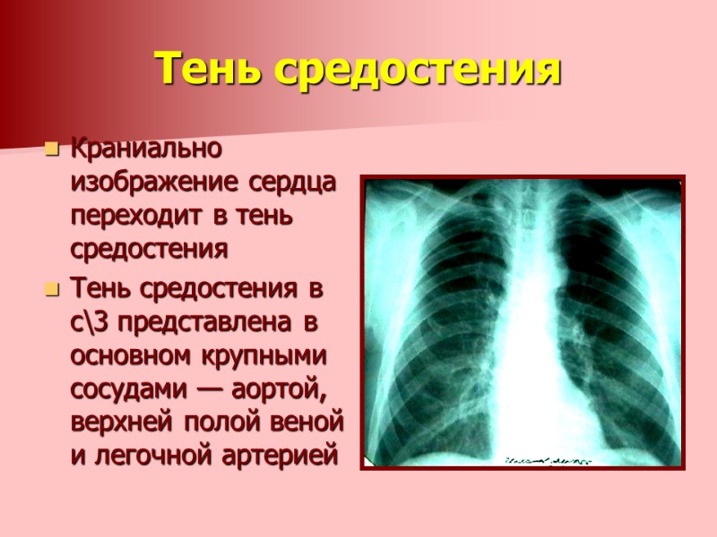 Тень средостения Краниально изображение сердца переходит в тень средостения Тень средостения в с\3 представлена